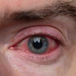 pink eye infection canberra